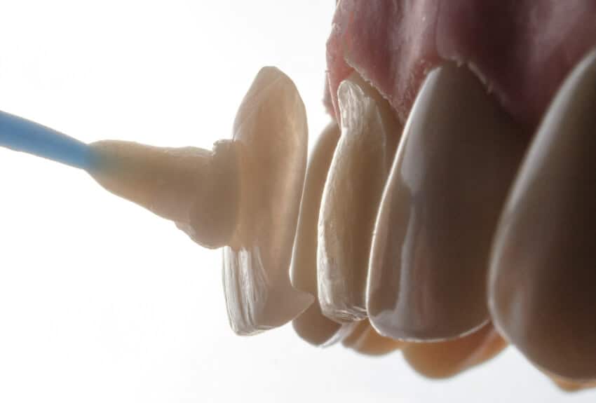 Dental Porcelain Veneers