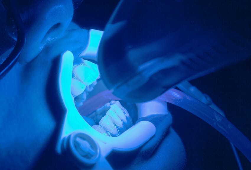 Dental Teeth Whitening