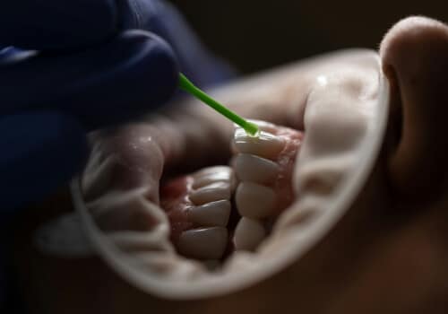 Laser Cavity Treatment