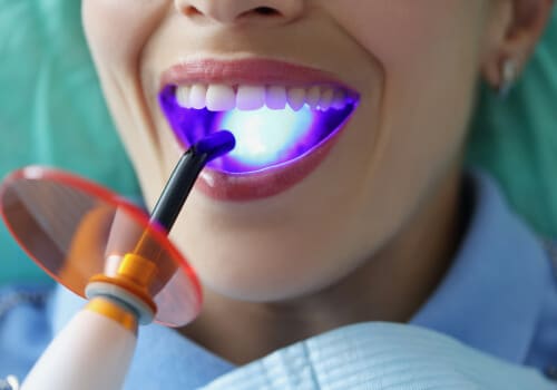 Laser Teeth Whitening